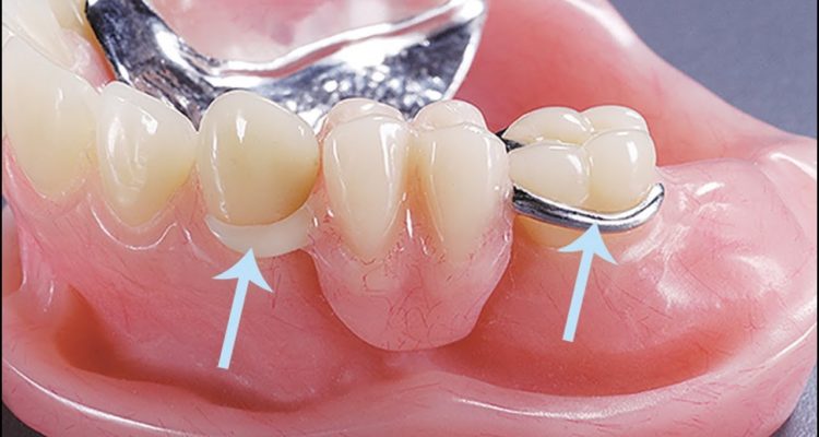 Prótese Dentárias